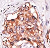 GDF3 Antibody - Formalin-fixed and paraffin-embedded human cancer tissue reacted with the primary antibody, which was peroxidase-conjugated to the secondary antibody, followed by DAB staining. This data demonstrates the use of this antibody for immunohistochemistry; clinical relevance has not been evaluated. BC = breast carcinoma; HC = hepatocarcinoma.