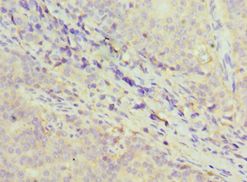 GDF5 / GDF-5 Antibody - Immunohistochemistry of paraffin-embedded human rectal cancer using antibody at 1:100 dilution.