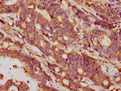 GDF5 / GDF-5 Antibody - IHC image of GDF5 Antibody diluted at 1:132 and staining in paraffin-embedded human colon cancer performed on a Leica BondTM system. After dewaxing and hydration, antigen retrieval was mediated by high pressure in a citrate buffer (pH 6.0). Section was blocked with 10% normal goat serum 30min at RT. Then primary antibody (1% BSA) was incubated at 4°C overnight. The primary is detected by a biotinylated secondary antibody and visualized using an HRP conjugated SP system.