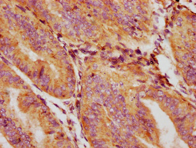 GDF5 / GDF-5 Antibody - IHC image of GDF5 Antibody diluted at 1:132 and staining in paraffin-embedded human endometrial cancer performed on a Leica BondTM system. After dewaxing and hydration, antigen retrieval was mediated by high pressure in a citrate buffer (pH 6.0). Section was blocked with 10% normal goat serum 30min at RT. Then primary antibody (1% BSA) was incubated at 4°C overnight. The primary is detected by a biotinylated secondary antibody and visualized using an HRP conjugated SP system.