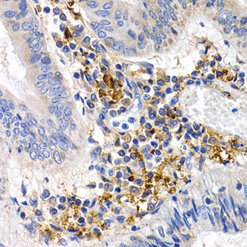 GDF5 / GDF-5 Antibody - Immunohistochemistry of paraffin-embedded human colon cancer tissue.