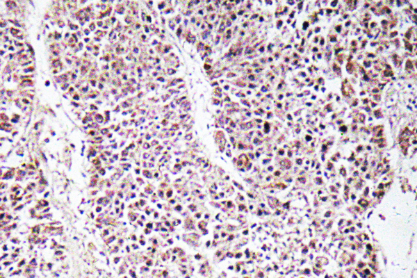 GDF9 / GDF-9 Antibody - Immunohistochemistry analysis of GDF-9 antibody in paraffin-embedded human liver carcinoma tissue.