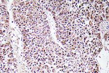GDF9 / GDF-9 Antibody - Immunohistochemistry analysis of GDF-9 antibody in paraffin-embedded human liver carcinoma tissue.