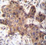 GDF9 / GDF-9 Antibody - GDF9 Antibody immunohistochemistry of formalin-fixed and paraffin-embedded human breast carcinoma followed by peroxidase-conjugated secondary antibody and DAB staining.