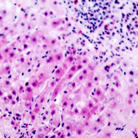 GDF9 / GDF-9 Antibody - Immunohistochemical analysis of GDF9 staining in human liver cancer formalin fixed paraffin embedded tissue section. The section was pre-treated using heat mediated antigen retrieval with sodium citrate buffer (pH 6.0). The section was then incubated with the antibody at room temperature and detected using an HRP conjugated compact polymer system. AEC was used as the chromogen. The section was then counterstained with hematoxylin and mounted with DPX.