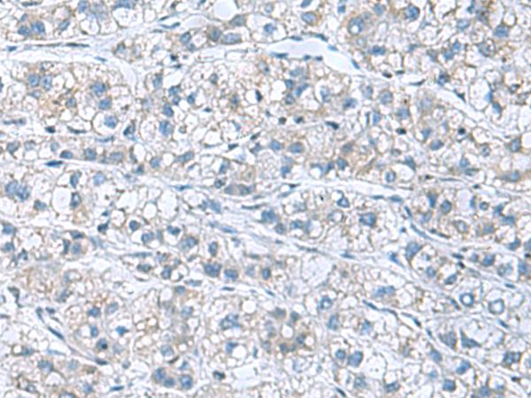 GDF9 / GDF-9 Antibody - Immunohistochemistry of paraffin-embedded Human liver cancer tissue  using GDF9 Polyclonal Antibody at dilution of 1:55(×200)