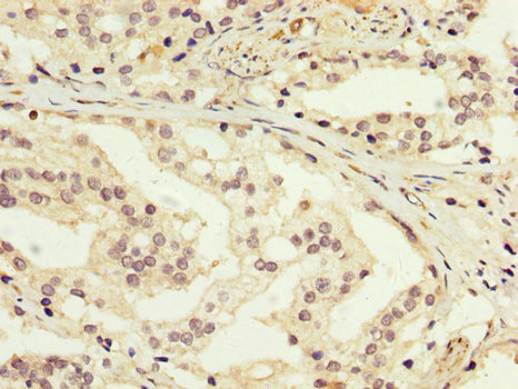 GDI1 Antibody - Immunohistochemistry image at a dilution of 1:200 and staining in paraffin-embedded human prostate cancer performed on a Leica BondTM system. After dewaxing and hydration, antigen retrieval was mediated by high pressure in a citrate buffer (pH 6.0) . Section was blocked with 10% normal goat serum 30min at RT. Then primary antibody (1% BSA) was incubated at 4 °C overnight. The primary is detected by a biotinylated secondary antibody and visualized using an HRP conjugated SP system.