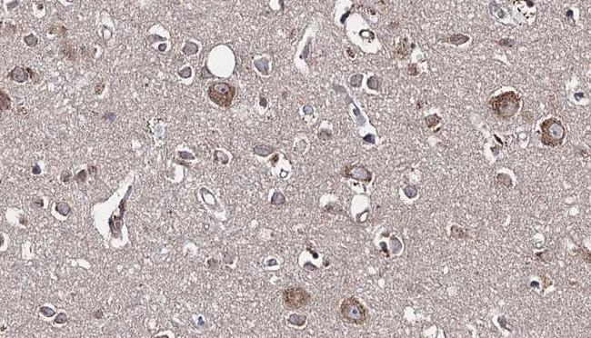 GDI1 Antibody - 1:100 staining human brain carcinoma tissue by IHC-P. The sample was formaldehyde fixed and a heat mediated antigen retrieval step in citrate buffer was performed. The sample was then blocked and incubated with the antibody for 1.5 hours at 22°C. An HRP conjugated goat anti-rabbit antibody was used as the secondary.