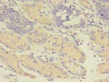 GDI2 Antibody - Immunohistochemistry of paraffin-embedded human gastric cancer using antibody at 1:100 dilution.  This image was taken for the unconjugated form of this product. Other forms have not been tested.