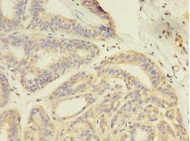 GDI2 Antibody - Immunohistochemistry of paraffin-embedded human breast cancer using antibody at 1: 100 dilution.  This image was taken for the unconjugated form of this product. Other forms have not been tested.