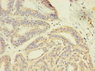 GDI2 Antibody - Immunohistochemistry of paraffin-embedded human breast cancer using GDI2 Antibody at dilution of 1:100