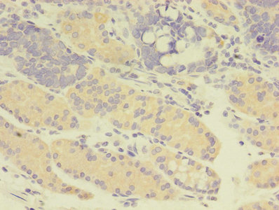 GDI2 Antibody - Immunohistochemistry of paraffin-embedded human gastric cancer using GDI2 Antibody at dilution of 1:100