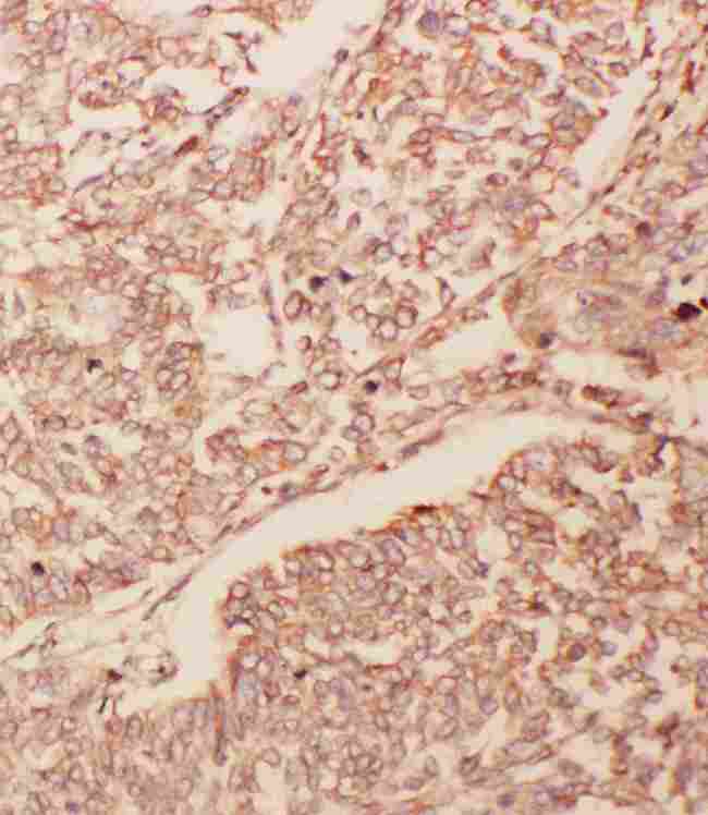 GDNF Antibody - Anti-GDNF antibody, IHC(P): Human Lung Cancer Tissue