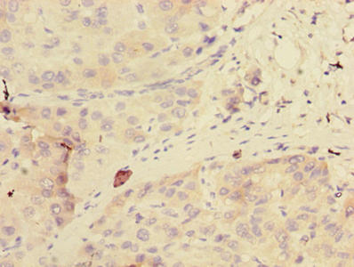 GDPD2 / GDE3 Antibody - Immunohistochemistry of paraffin-embedded human liver cancer using GDPD2 Antibody at dilution of 1:100