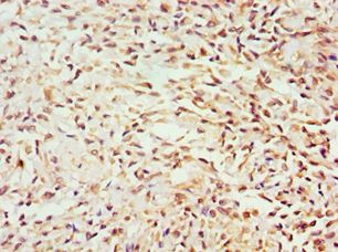 GEM / KIR Antibody - Immunohistochemistry of paraffin-embedded human breast cancer using antibody at 1:100 dilution.