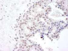 GEMIN4 Antibody - Detection of Human Gemin4 by Immunohistochemistry. Sample: FFPE section of human breast carcinoma. Antibody: Affinity purified rabbit anti-Gemin4 used at a dilution of 1:250. Epitope Retrieval Buffer-High pH (IHC-101J) was substituted for Epitope Retrieval Buffer-Reduced pH.