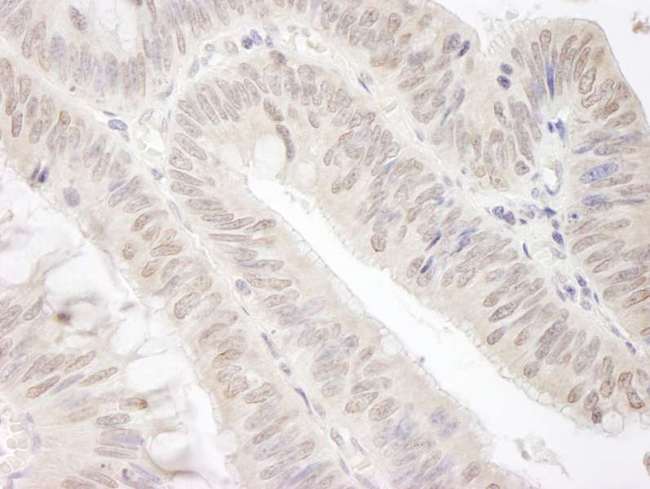 GEMIN4 Antibody - Detection of Human Gemin4 by Immunohistochemistry. Sample: FFPE section of human colon carcinoma. Antibody: Affinity purified rabbit anti-Gemin4 used at a dilution of 1:250. Epitope Retrieval Buffer-High pH (IHC-101J) was substituted for Epitope Retrieval Buffer-Reduced pH.