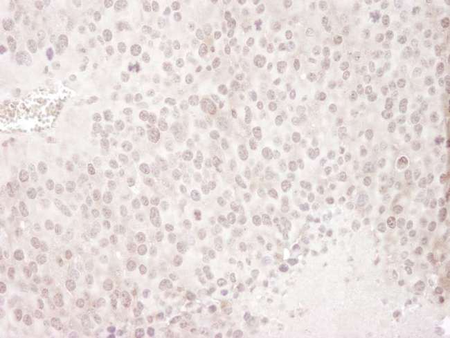 GEMIN4 Antibody - Detection of Mouse Gemin4 by Immunohistochemistry. Sample: FFPE section of mouse renal cell carcinoma. Antibody: Affinity purified rabbit anti-Gemin4 used at a dilution of 1:250. Epitope Retrieval Buffer-High pH (IHC-101J) was substituted for Epitope Retrieval Buffer-Reduced pH.