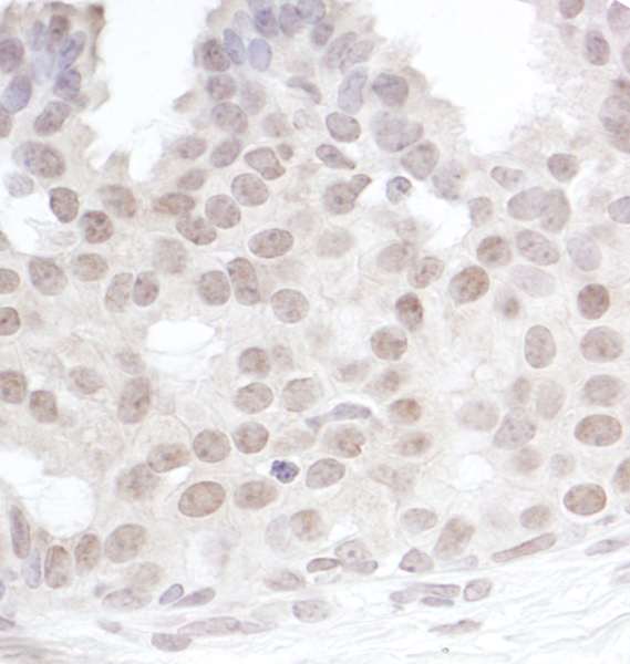 GEMIN4 Antibody - Detection of Human Gemin4 by Immunohistochemistry. Sample: FFPE section of human breast carcinoma. Antibody: Affinity purified rabbit anti-Gemin4 used at a dilution of 1:200 (1 Detection: DAB.
