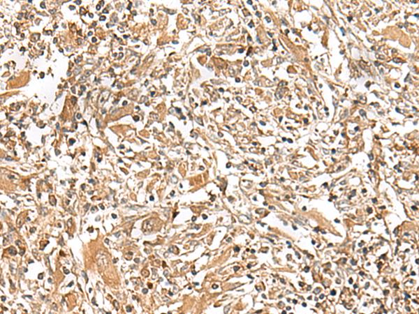 GEMIN4 Antibody - Immunohistochemistry of paraffin-embedded Human liver cancer tissue  using GEMIN4 Polyclonal Antibody at dilution of 1:30(×200)