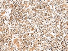 GEMIN4 Antibody - Immunohistochemistry of paraffin-embedded Human liver cancer tissue  using GEMIN4 Polyclonal Antibody at dilution of 1:30(×200)