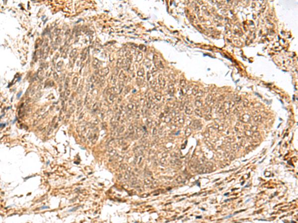 GEMIN4 Antibody - Immunohistochemistry of paraffin-embedded Human esophagus cancer tissue  using GEMIN4 Polyclonal Antibody at dilution of 1:30(×200)