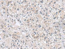 GEMIN7 Antibody - Immunohistochemistry of paraffin-embedded Human liver cancer tissue  using GEMIN7 Polyclonal Antibody at dilution of 1:70(×200)