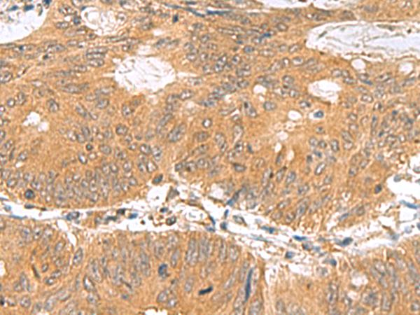 GEMIN7 Antibody - Immunohistochemistry of paraffin-embedded Human colorectal cancer tissue  using GEMIN7 Polyclonal Antibody at dilution of 1:70(×200)