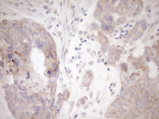 GEMIN8 Antibody - Immunohistochemical staining of paraffin-embedded Adenocarcinoma of Human endometrium tissue using anti-GEMIN8 mouse monoclonal antibody. (Heat-induced epitope retrieval by 1mM EDTA in 10mM Tris buffer. (pH8.5) at 120°C for 3 min. (1:150)