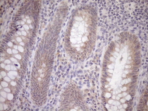 GEMIN8 Antibody - Immunohistochemical staining of paraffin-embedded Adenocarcinoma of Human colon tissue using anti-GEMIN8 mouse monoclonal antibody. (Heat-induced epitope retrieval by 1mM EDTA in 10mM Tris buffer. (pH8.5) at 120°C for 3 min. (1:150)