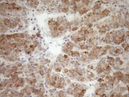 GEMIN8 Antibody - Immunohistochemical staining of paraffin-embedded Carcinoma of Human liver tissue using anti-GEMIN8 mouse monoclonal antibody. (Heat-induced epitope retrieval by 1mM EDTA in 10mM Tris buffer. (pH8.5) at 120°C for 3 min. (1:150)