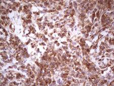 GEMIN8 Antibody - Immunohistochemical staining of paraffin-embedded Carcinoma of Human lung tissue using anti-GEMIN8 mouse monoclonal antibody.  heat-induced epitope retrieval by 1 mM EDTA in 10mM Tris, pH8.5, 120C for 3min)