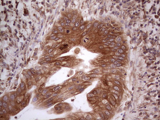 GEMIN8 Antibody - Immunohistochemical staining of paraffin-embedded Carcinoma of Human pancreas tissue using anti-GEMIN8 mouse monoclonal antibody.  heat-induced epitope retrieval by 1 mM EDTA in 10mM Tris, pH8.5, 120C for 3min)