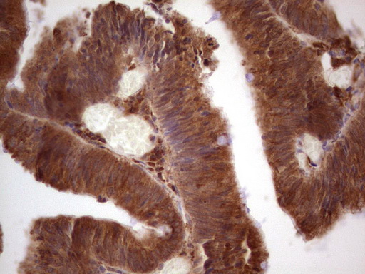 GEMIN8 Antibody - Immunohistochemical staining of paraffin-embedded Adenocarcinoma of Human colon tissue using anti-GEMIN8 mouse monoclonal antibody.  heat-induced epitope retrieval by 1 mM EDTA in 10mM Tris, pH8.5, 120C for 3min)