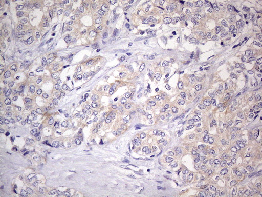 GEMIN8 Antibody - Immunohistochemical staining of paraffin-embedded Carcinoma of Human liver tissue using anti-GEMIN8 mouse monoclonal antibody. (Heat-induced epitope retrieval by 1mM EDTA in 10mM Tris buffer. (pH8.0) at 110C for 10 min. (1:400)