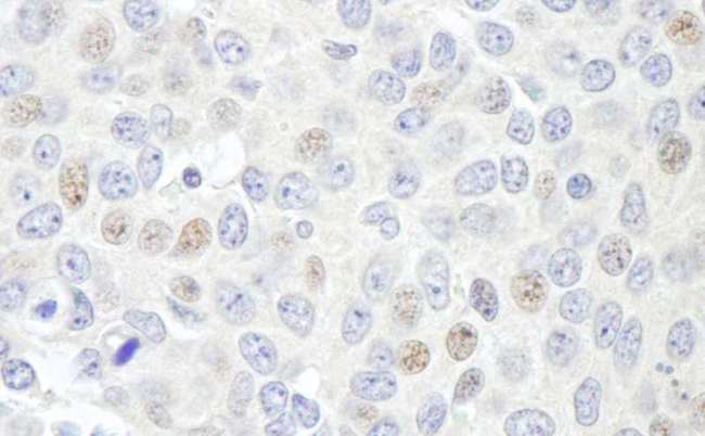 Geminin Antibody - Detection of Human Geminin by Immunohistochemistry. Sample: FFPE section of human breast carcinoma. Antibody: Affinity purified rabbit anti-Geminin used at a dilution of 1:5000 (0.2 Detection: DAB.