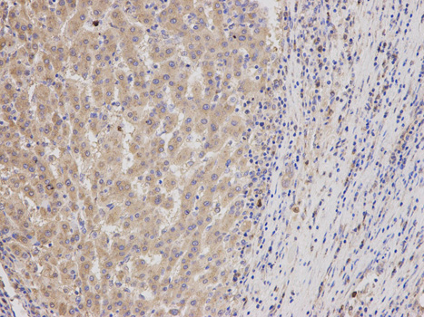 Geminin Antibody - Immunohistochemistry of paraffin-embedded human liver cancer using GMNN antibody at dilution of 1:200 (200x lens).