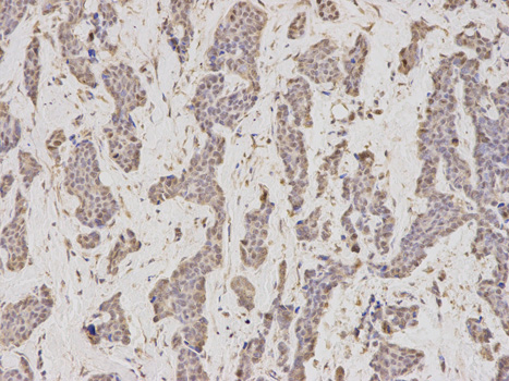 Geminin Antibody - Immunohistochemistry of paraffin-embedded human breast cancer using GMNN antibody at dilution of 1:200 (200x lens).