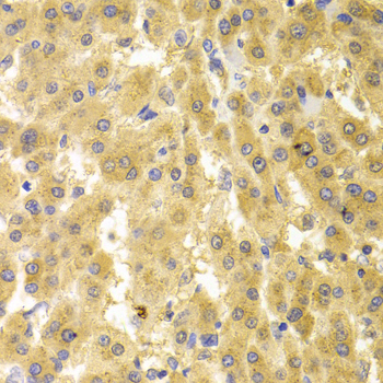 Geminin Antibody - Immunohistochemistry of paraffin-embedded human liver cancer tissue.