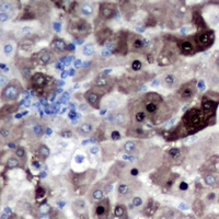 Geminin Antibody - Immunohistochemical analysis of Geminin staining in human liver cancer formalin fixed paraffin embedded tissue section. The section was pre-treated using heat mediated antigen retrieval with sodium citrate buffer (pH 6.0). The section was then incubated with the antibody at room temperature and detected using an HRP conjugated compact polymer system. DAB was used as the chromogen. The section was then counterstained with hematoxylin and mounted with DPX.