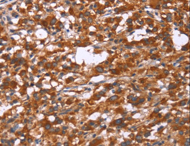 Gephyrin Antibody - Immunohistochemistry of paraffin-embedded Human gastric cancer using GPHN Polyclonal Antibody at dilution of 1:30.