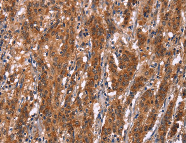 Gephyrin Antibody - Immunohistochemistry of paraffin-embedded Human gastric cancer using GPHN Polyclonal Antibody at dilution of 1:30.