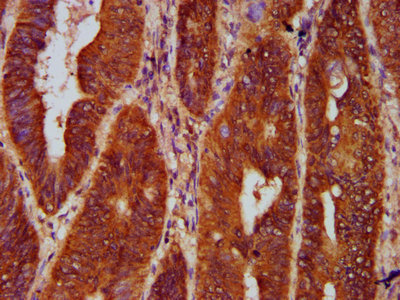 Gephyrin Antibody - Immunohistochemistry Dilution at 1:300 and staining in paraffin-embedded human colon cancer performed on a Leica BondTM system. After dewaxing and hydration, antigen retrieval was mediated by high pressure in a citrate buffer (pH 6.0). Section was blocked with 10% normal Goat serum 30min at RT. Then primary antibody (1% BSA) was incubated at 4°C overnight. The primary is detected by a biotinylated Secondary antibody and visualized using an HRP conjugated SP system.