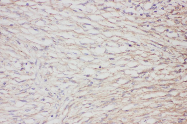 GFAP Antibody - GFAP antibody IHC-paraffin: Human meningioma Tissue.