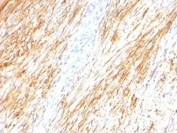 GFAP Antibody - Formalin-fixed, paraffin-embedded human Schwannoma stained with GFAP antibody (ASTRO/789).  This image was taken for the unmodified form of this product. Other forms have not been tested.