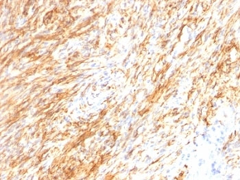 GFAP Antibody - Formalin-fixed, paraffin-embedded human Schwannoma stained with GFAP antibody (GA-5 + ASTRO/789).  This image was taken for the unmodified form of this product. Other forms have not been tested.