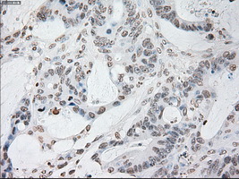 GFAP Antibody - IHC of paraffin-embedded Adenocarcinoma of colon tissue using anti-GFAP mouse monoclonal antibody. (Dilution 1:50).