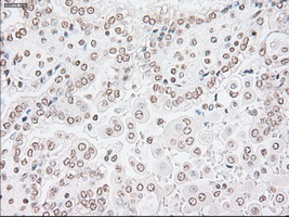GFAP Antibody - IHC of paraffin-embedded Carcinoma of kidney tissue using anti-GFAP mouse monoclonal antibody. (Dilution 1:50).