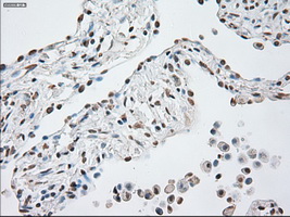 GFAP Antibody - IHC of paraffin-embedded Carcinoma of lung tissue using anti-GFAP mouse monoclonal antibody. (Dilution 1:50).