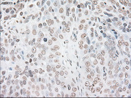 GFAP Antibody - IHC of paraffin-embedded Adenocarcinoma of ovary tissue using anti-GFAP mouse monoclonal antibody. (Dilution 1:50).